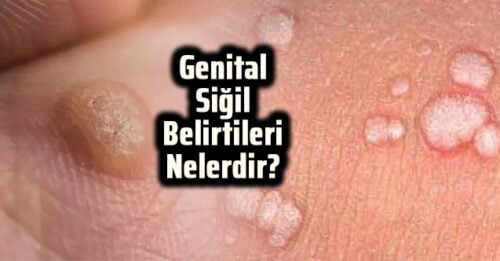 Genital Siğil